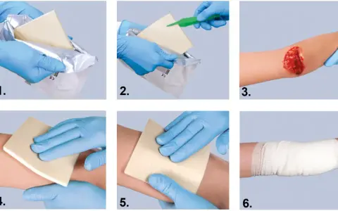 Instrukcja: opatrunek hemostatyczny jak używać. Wyjmij, przygotuj, przyłóż do rany, dociśnij, zabezpiecz bandażem.