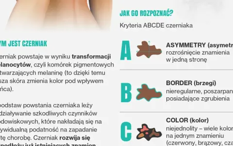 Jak rozpoznać czerniaka? Poznaj kryteria ABCDE: asymetria, brzegi, kolor, średnica i ewolucja znamienia. Dbaj o swoją skórę!