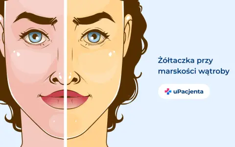 Żółtaczka przy marskości wątroby, jeden z objawów alkoholowego zapalenia wątroby, powoduje zażółcenie skóry.
