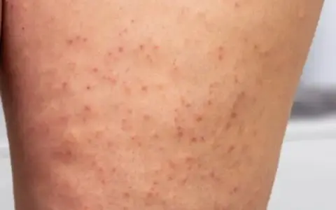 Eingewachsenes Haar am Bein: Ursachen, Behandlung und Vorbeugung