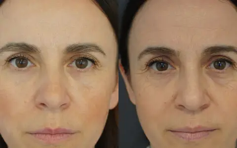 Nahaufnahme zweier Gesichter, die die Entwicklung von reifer Haut ab wann zeigen. Falten um die Augen und auf der Stirn sind sichtbar.