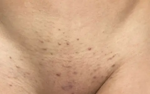 Red bumps and irritation on the skin, indicative of folliculitis and a histamine reaction after waxing.