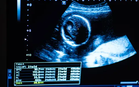Obraz usg ciąży pokazuje rozwijający się płód. Na ekranie widoczne są pomiary i wiek ciąży.