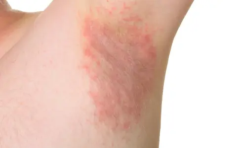 Irritazione cutanea sotto le ascelle, con chiazze rosse e sensazione di prurito sotto le ascelle senza rossore visibile.
