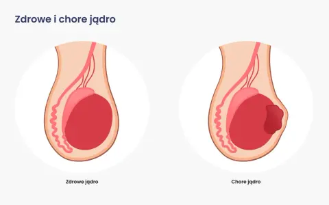 Ilustracja porównuje zdrowe jądro z chorym, na którym widoczny jest guz, wskazujący na raka moszny.