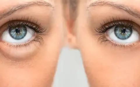 Gros plan sur des yeux bleus, montrant des poches sous les yeux. Le bicarbonate de soude est une astuce maison pour les atténuer.