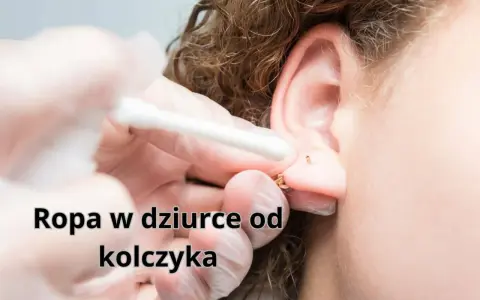 Ropa w dziurce od kolczyka, widoczna podczas czyszczenia ucha wacikiem.