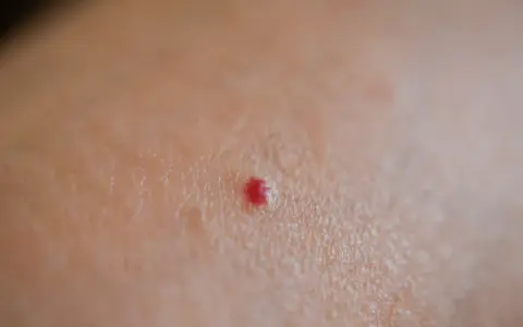 Una piccola macchia rossa sulla pelle, un neo rubino, senza alcun prurito.