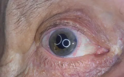 Occhio con iride verde-grigia e riflessi luminosi. Si nota una piccola apertura nell'iride, tipica di un intervento di iridectomia cos'è.