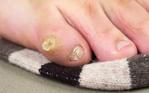 Un oignon au pied, un remède de grand-mère à base d'oignon pourrait aider. Gros plan sur un orteil avec un cor et un ongle abîmé.