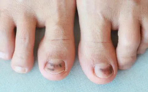 Gros plan sur des orteils, dont deux présentent une plaque de l'ongle abîmée avec des ecchymoses sombres, suggérant un traumatisme.