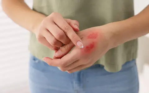 Mano con bruciatura da piastra, arrossata e con crema applicata.