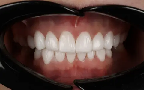 Piękne, białe zęby po zabiegu dental bonding. Uśmiech jak z reklamy!