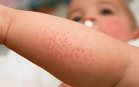 Bébé avec un bouton de chaleur sur le bras. Petits points rouges sur la peau.
