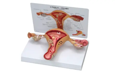 Model anatomiczny narządu rodnego kobiety z widoczną torbielą na jajniku.