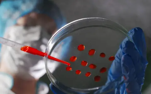 Ricerca medica: gocce rosse su piastra di Petri, parte di un test per capire se hai un tumore.