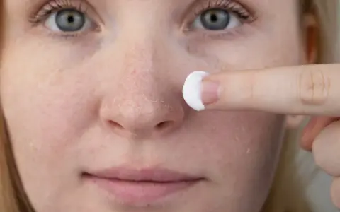 Une personne applique une crème sur son visage, montrant des zones de peau sèche et squameuse, typiques du psoriasis du visage.