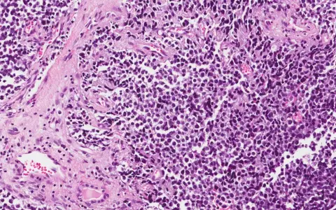 Microscopia di rabdomiosarcoma alveolare: cellule tumorali con nuclei scuri e citoplasma scarso, disposte in nidi separati da tessuto connettivo.