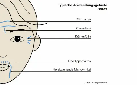 Schema zeigt typische Anwendungsgebiete für Botox, z.B. Stirnfalten, Zornesfalten, Krähenfüße.