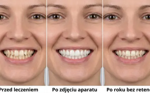 Uśmiech przed leczeniem, po zdjęciu aparatu i po roku bez retencji. Aparat retencyjny pomaga utrzymać efekt.