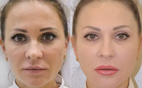 Kwas hialuronowy: Sekret nawilżenia i młodej skóry? Sprawdź!