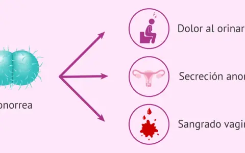 La gonorrea puede causar dolor al orinar, secreción anormal y sangrado vaginal.