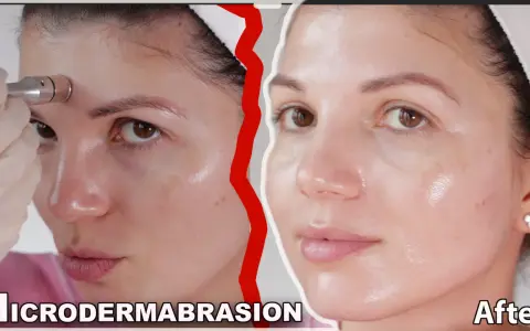 Woman using a microdermabrasion device on her forehead. Learn how to clean microdermabrasion tips for best results.