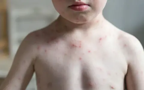 Kind mit roten Pusteln am Oberkörper und Hals. Die Haut wirkt blass, was Fragen aufwirft: "Warum ist mein Kind so blass?