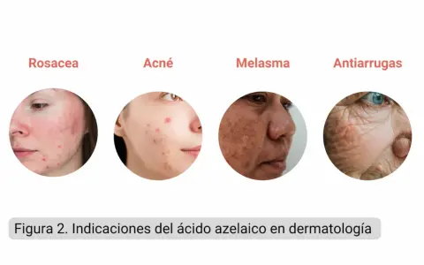 El ácido azelaico sirve para tratar rosácea, acné, melasma y arrugas, mostrando su versatilidad en dermatología.