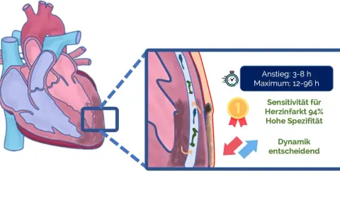 Herzinfarkt-Diagnostik: Ein erhöhter troponin wert ist entscheidend. Sensitivität 94%, Anstieg 3-8h, Maximum 12-96h. Dynamik zählt.