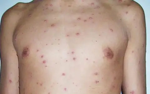 Torso y brazo de persona con granitos varicela leve, pequeños y rojizos, indicando una erupción cutánea.