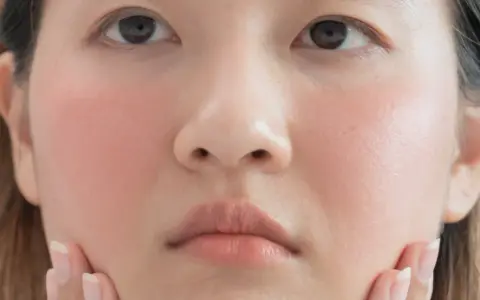 Gros plan sur le visage d'une jeune femme, ses joues rosées évoquant un doux **bouton soleil visage**. Ses mains effleurent délicatement sa peau.