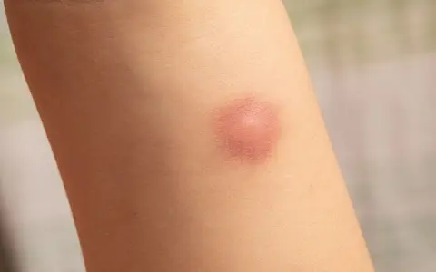 Obrzęk i zaczerwienienie na skórze po ugryzieniu pająka.