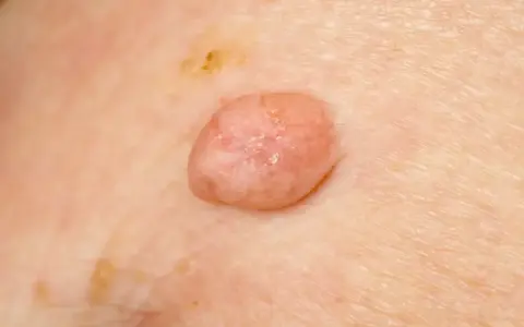 Zmiana skórna, która może być jednym z objawów wirusa HPV. Widoczny różowy, lekko łuszczący się brodawczak.
