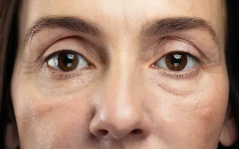 Nahaufnahme eines Gesichts, das schlaffe Haut unter den Augen zeigt, mit feinen Linien und Falten, die die Spuren der Zeit erzählen.