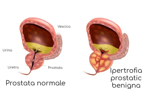 Confronto tra prostata normale e prostata infiammata, dove l'ipertrofia prostatica benigna comprime l'uretra, ostacolando il flusso urinario.