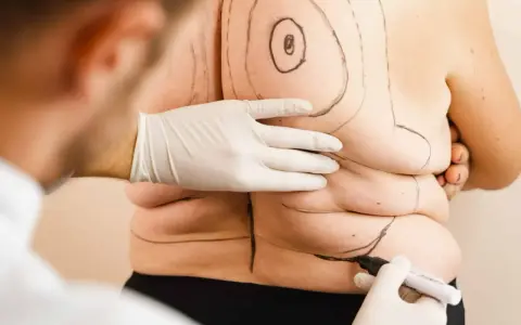 Liposukcja: Co to jest? Zrozum zabieg modelowania sylwetki