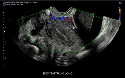 Ecografia pelvica con evidenza di vascolarizzazione anomala, possibile indicatore di tumore ovario.