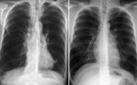 Zwei Röntgenaufnahmen des Brustkorbs zeigen Anzeichen von COPD. Ein rosa Puffer könnte zur Linderung der Symptome beitragen.