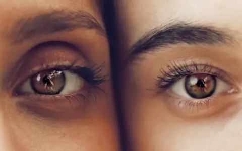 Dos ojos de cerca, uno con ojeras vasculares marcadas, el otro con piel lisa. Reflejos en los iris.