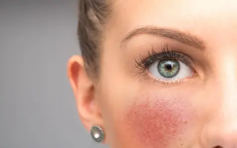 Was tun gegen rote Gesichtshaut? Effektive Tipps und Behandlungen