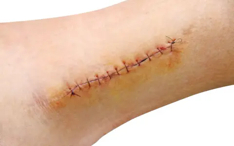 Ferita suturata con filo nero, con segni di arrossamento e possibile applicazione di amuchina disinfettante ferite per la guarigione.