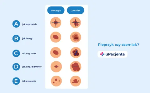 Porównanie pieprzyka i czerniaka: asymetria, brzegi, kolor, średnica i ewolucja. Jak wygląda czerniak skóry?