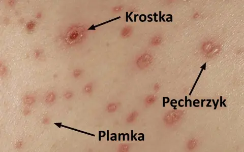 Zmiany skórne charakterystyczne dla ospy u dzieci: plamki, krostki i pęcherzyki.