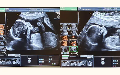 Badania prenatalne I trymestr: Co musisz wiedzieć? (do 70 znaków)