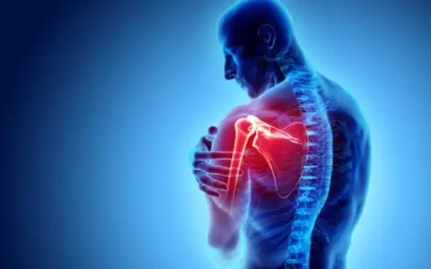 Anatomie d'un homme montrant une douleur vive à l'arrière de l'épaule, mise en évidence par une zone rouge intense.