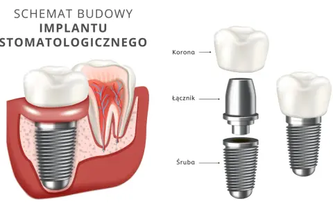 Schemat budowy implantu stomatologicznego. Dowiedz się, ile kosztuje wstawienie zęba i jak wygląda jego konstrukcja: śruba, łącznik i korona.