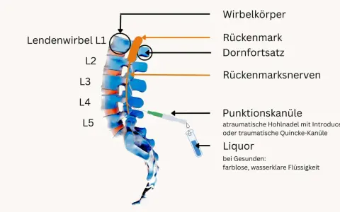 Illustration zeigt Lumbalpunktion mit Punktionskanüle im Bereich L4/L5. Mögliche Nervenreizung nach Lumbalpunktion wird durch die Nähe zum Rückenmark und den Nerven dargestellt.