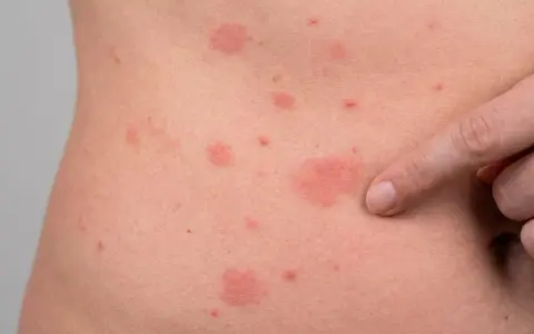 Rote Flecken und Quaddeln auf der Haut, ein deutlicher **ausschlag am bauch**. Ein Finger deutet auf eine der betroffenen Stellen.
