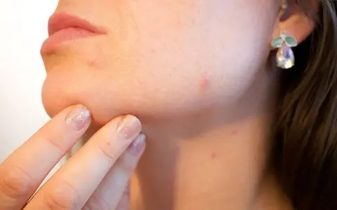 Pryszcze: Skuteczne metody usuwania i pielęgnacji. Kompleksowy przewodnik.